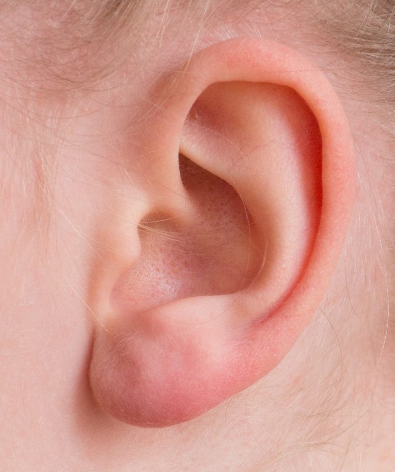 Close-up of an ear showing significant earwax accumulation.